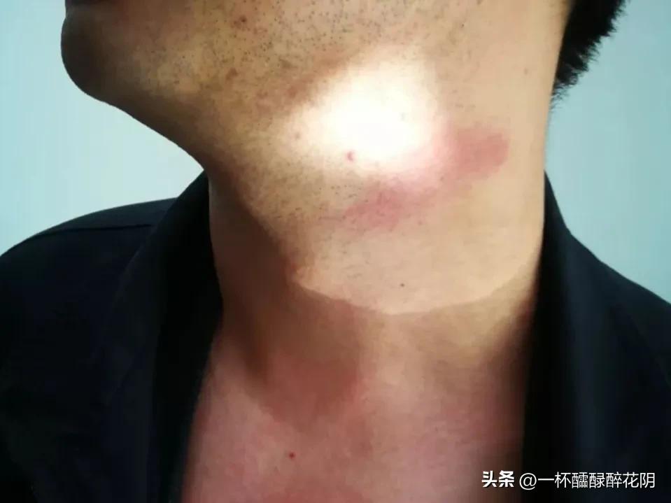 被人掐脖子报警了怎么处理,被人掐脖子可以还击吗