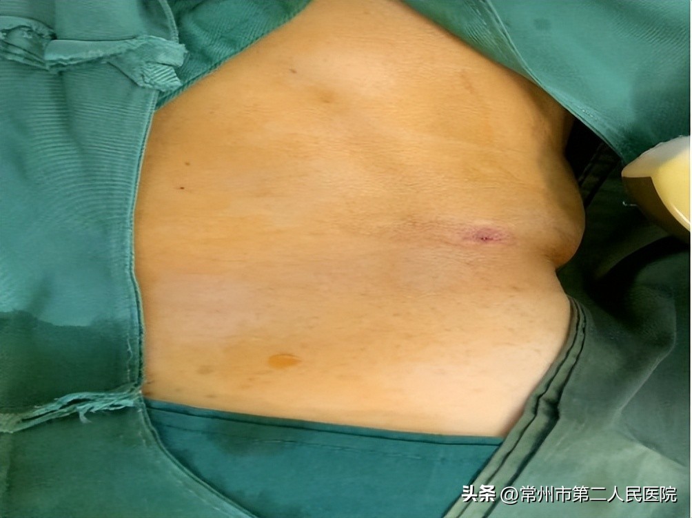 小针孔，用途多，漫画带你了解介入超声能做啥？