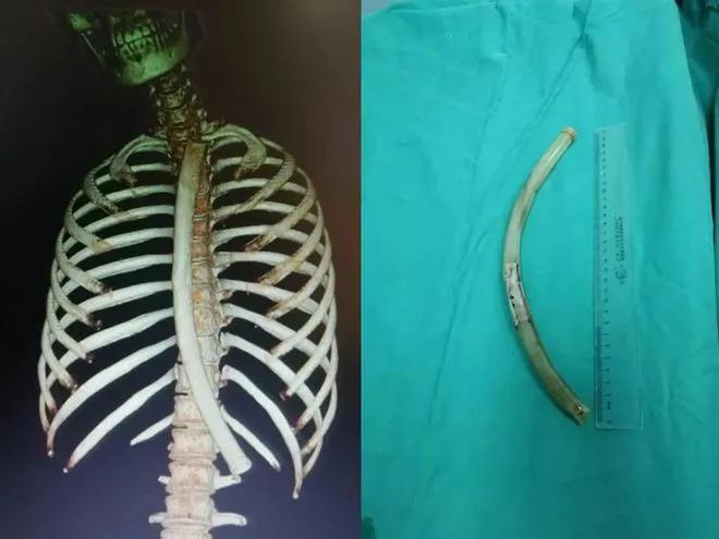 自虐成瘾？女孩竟把50cm“仙女管”吞进体内！