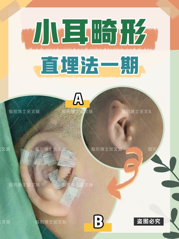 小耳畸形手术做了恢复图片,耳软骨超肋一定要搭支架吗