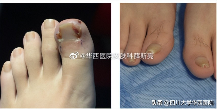 华西专家说，不是转你们，起码有一半的人从没有剪对过指甲儿！