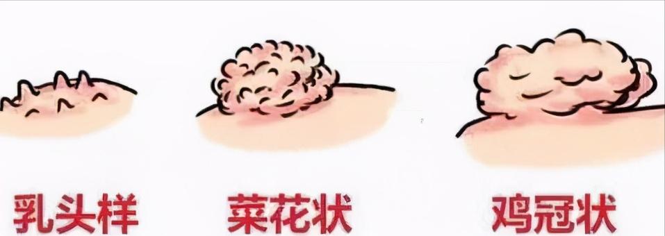 为爱鼓掌时，发现女友*体下**长疙瘩，是尖锐湿疣？