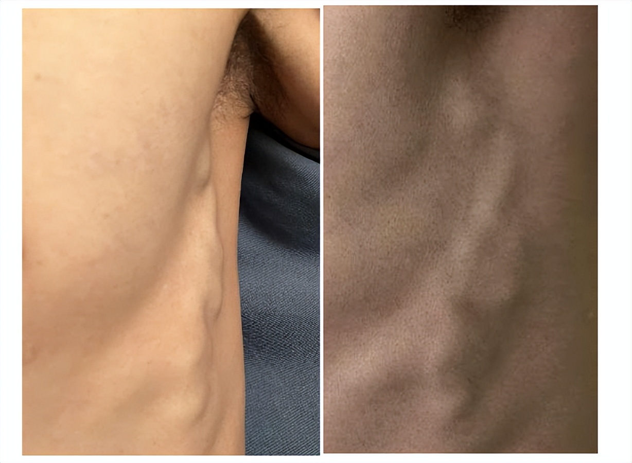 警惕老人脸肿,警惕中风年轻化