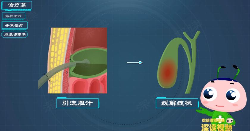 胆囊炎胆结石怎么保守治疗,胆结石胆囊炎胆绞痛发作