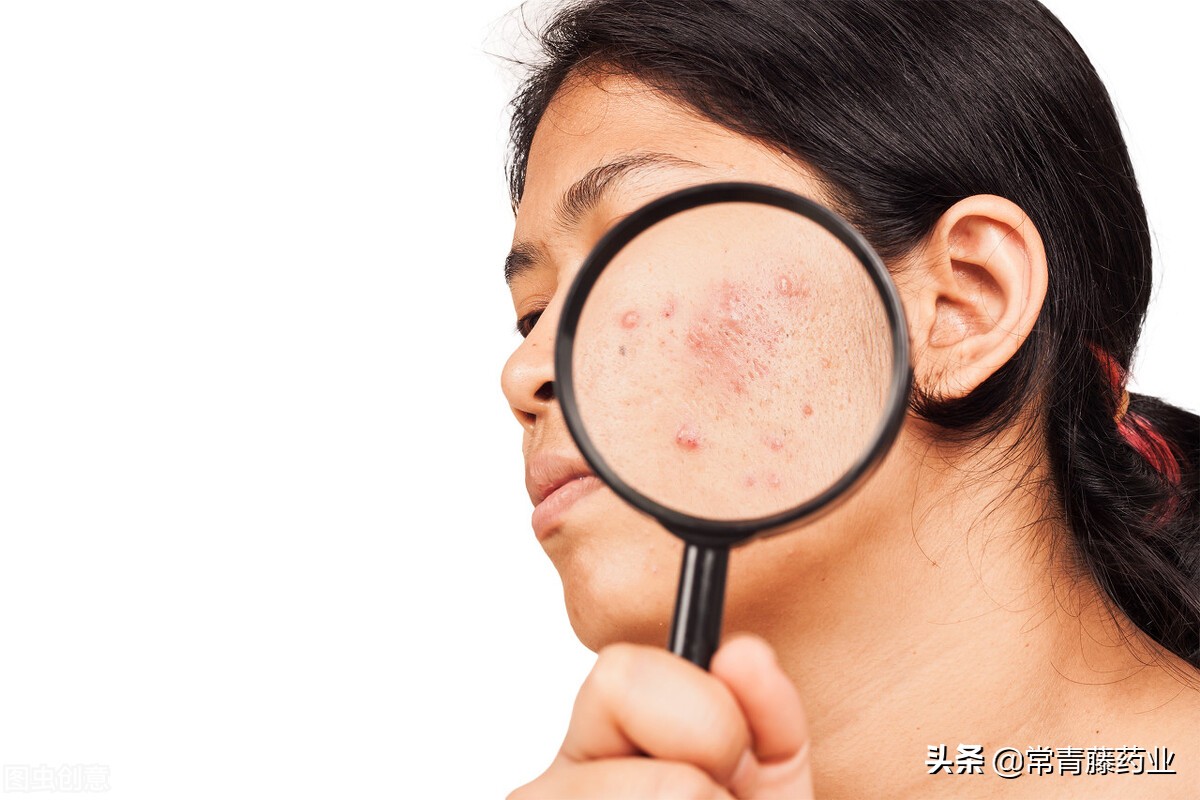 你有痘痘困扰你吗,你有被皮肤问题困扰过吗