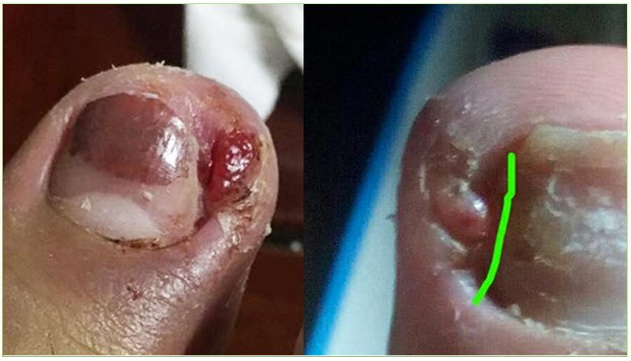 嵌甲危害大，防止有方法