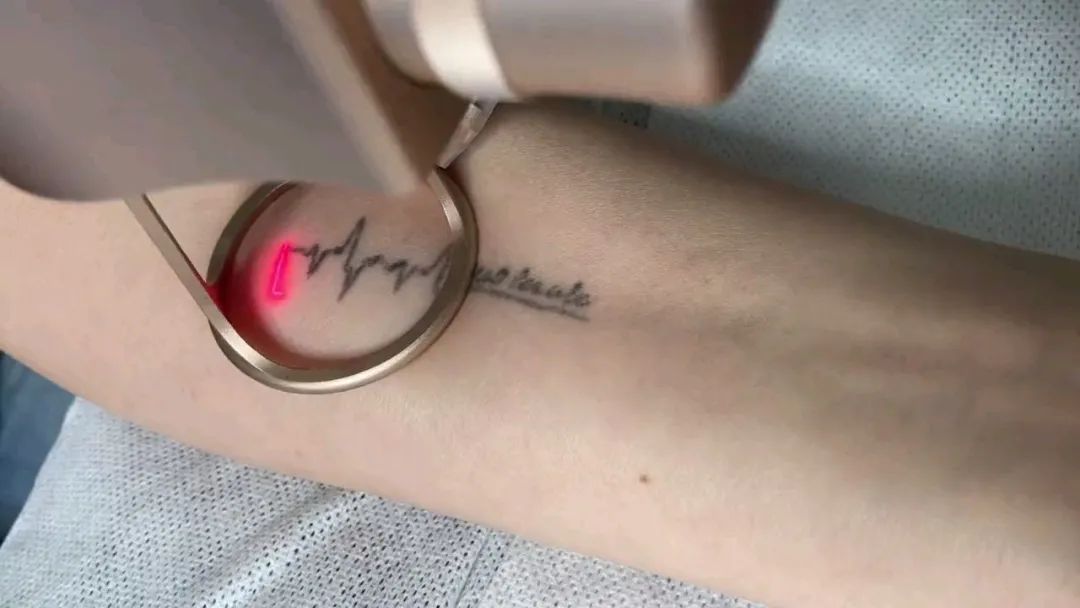 洗纹身科普,科普知识洗纹身