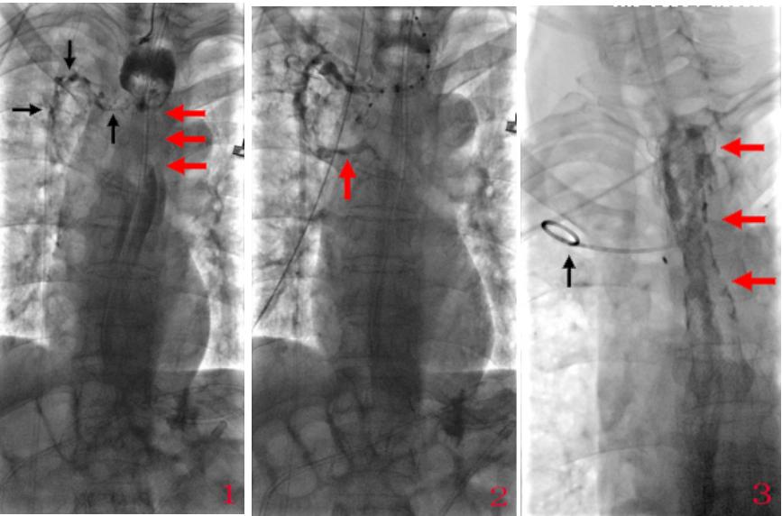 食管瘘外科手术治疗方法,气管食管瘘介入指南