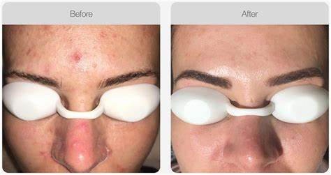 黑金光子嫩肤的功效与副作用图片,光子嫩肤能维持多久有副作用吗