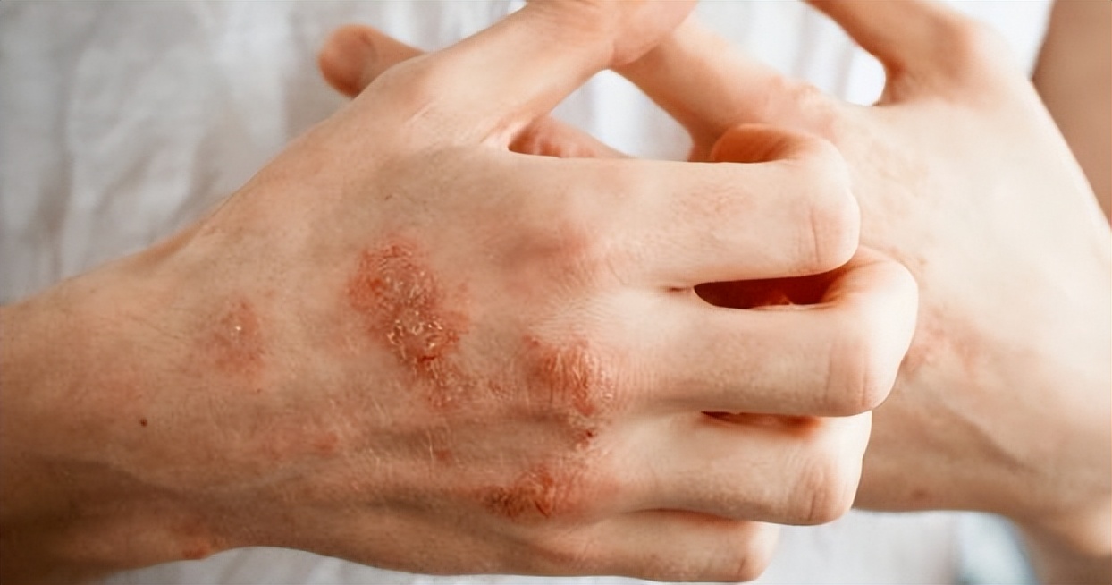 炉甘石洗剂功效多少钱一瓶,世卫组织推荐炉甘石