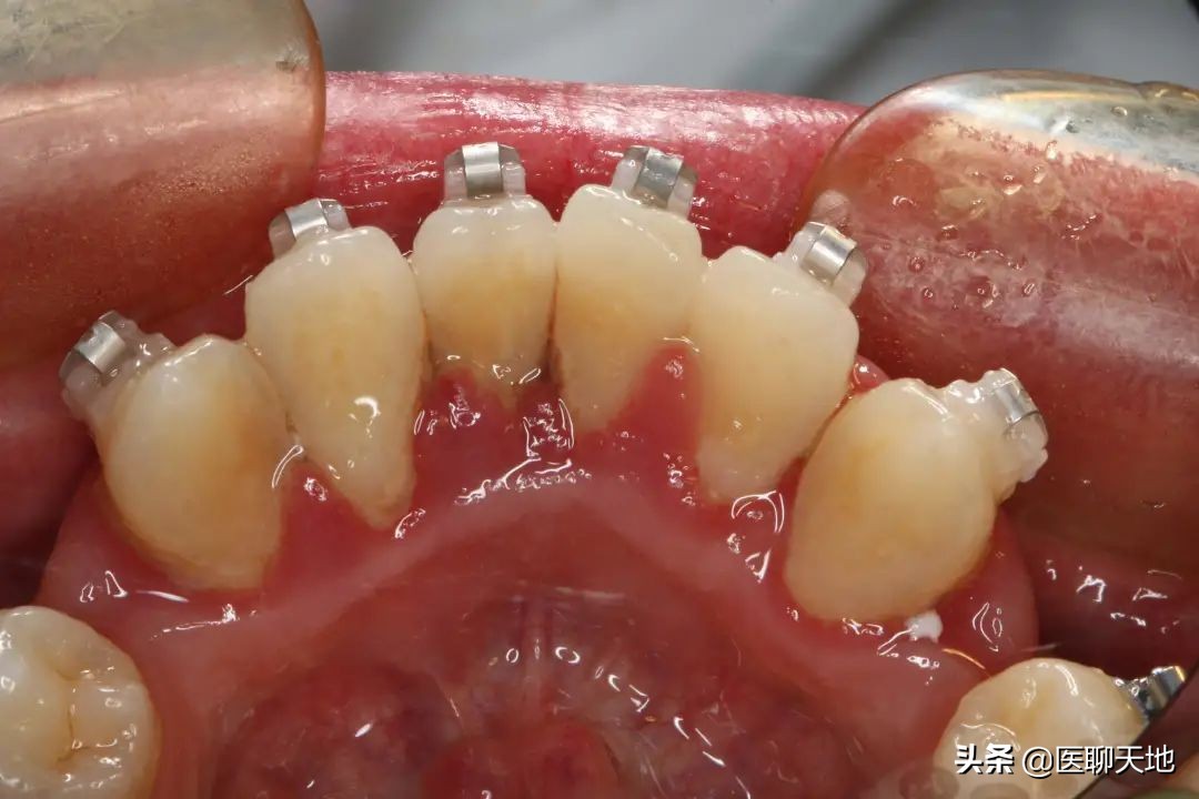 牙周病患者适合哪种正畸保持器,牙周病口腔正畸