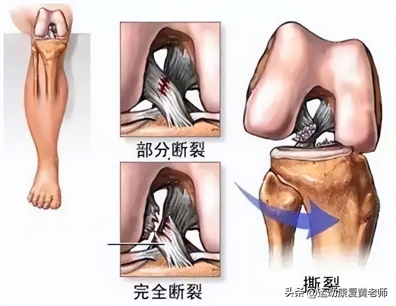 韧带受伤后怎么好得快,韧带受伤要多久才能恢复正常