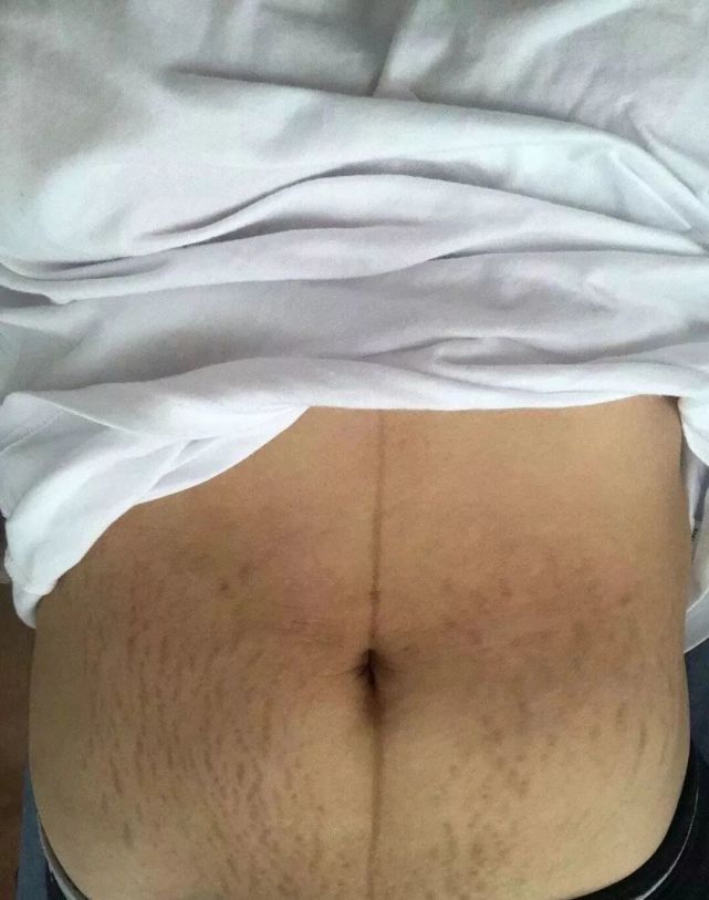 女明星难产,女明星剖腹产的原因