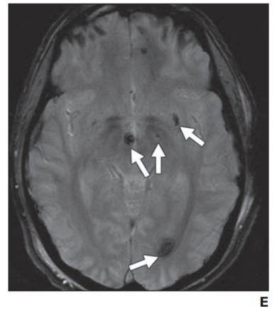脑水肿的影像,脑水肿形成机制生理学