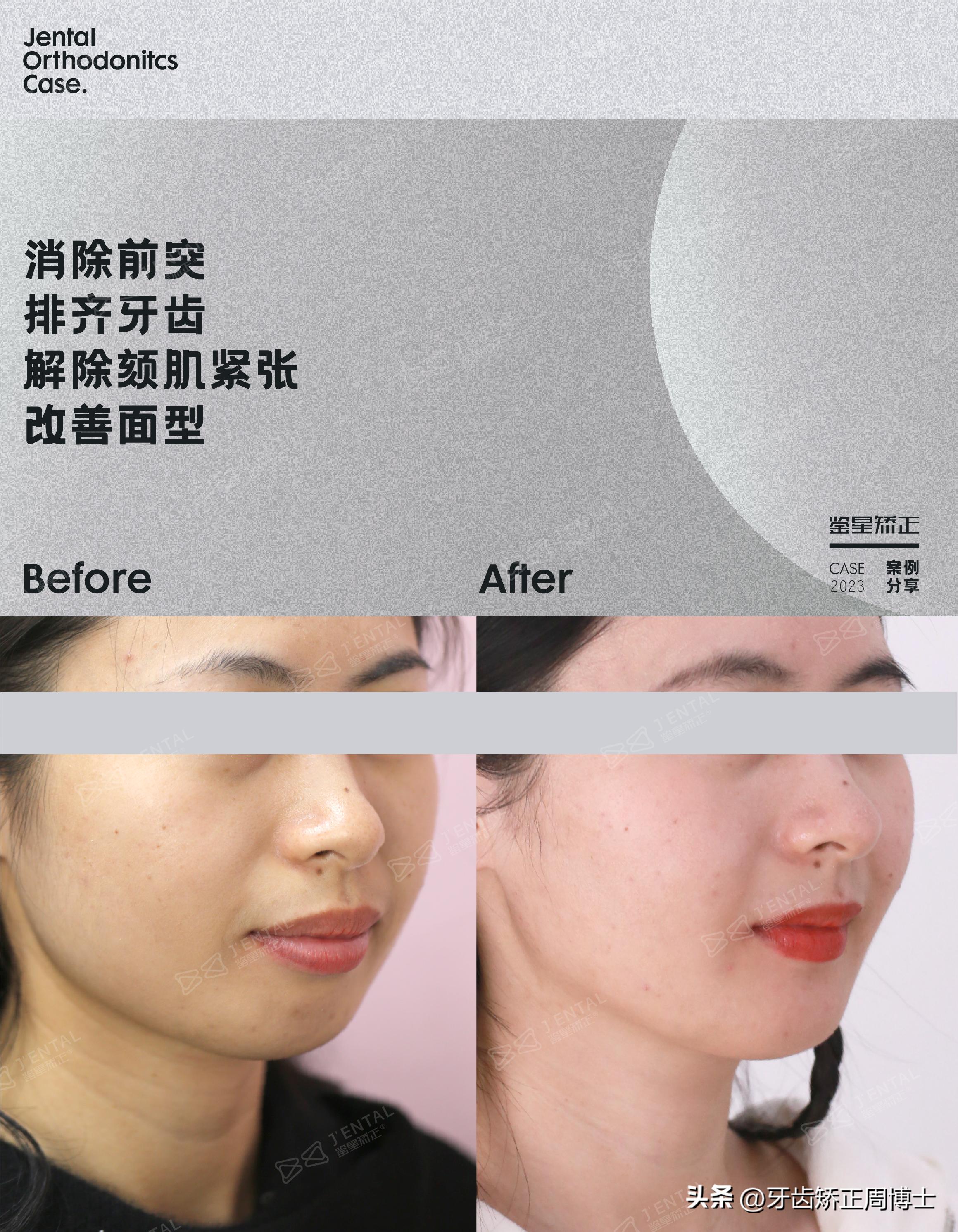 骨性前突下巴后缩可以矫正吗,上颌骨前突下巴后缩如何矫正