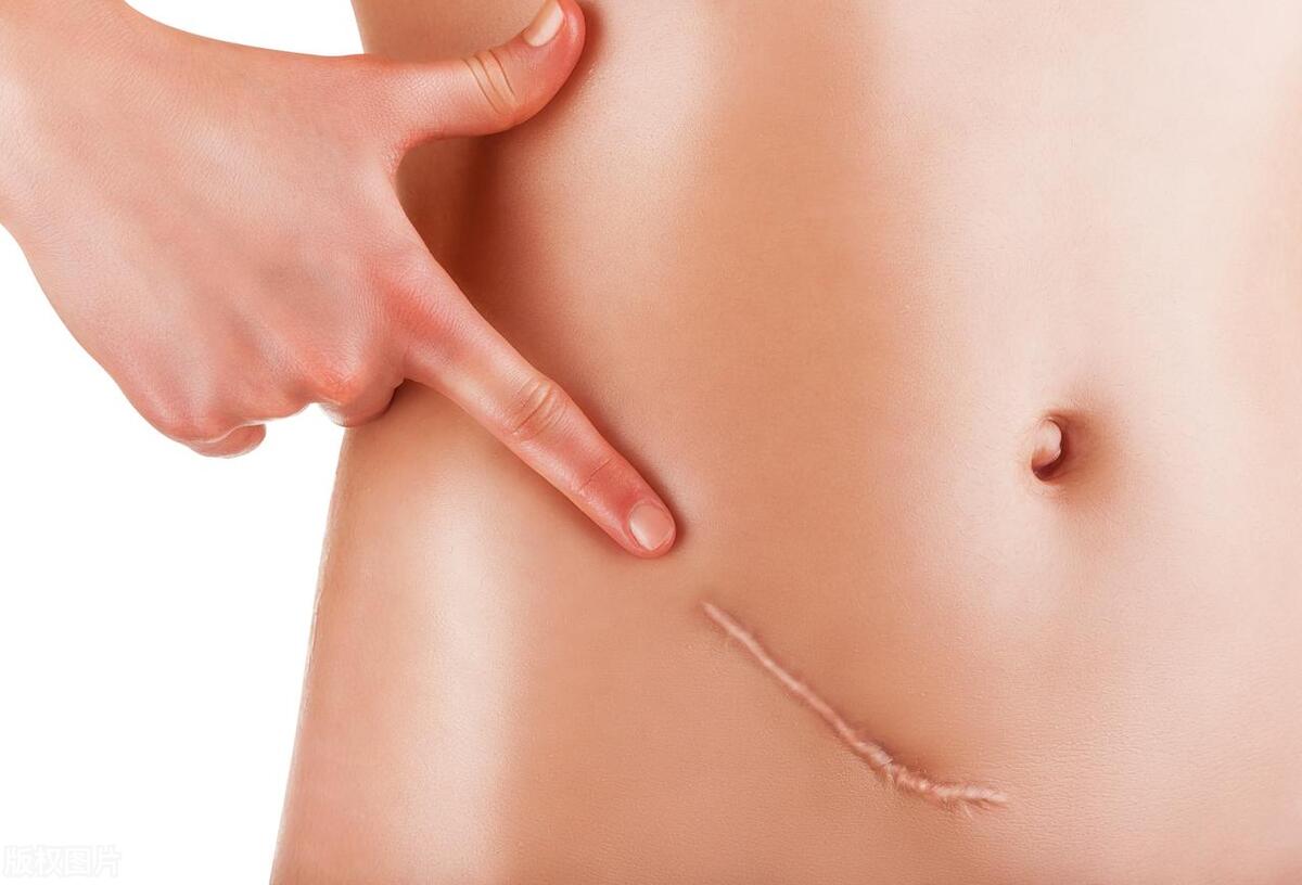 女朋友宫颈癌要分手吗,宫颈癌切除5年了