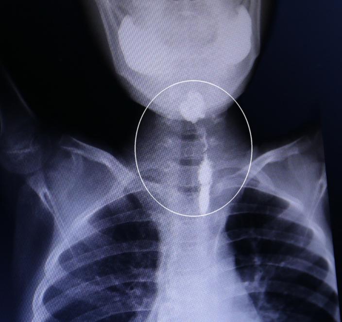 喉咙经常有炎症怎么回事,喉咙出现4个症状呼吸不畅