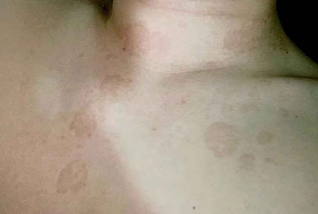 10种皮肤病特效药,皮肤病联合用药大全