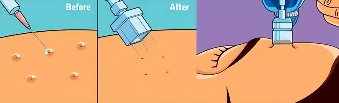 打水光针的痛苦,打水光针的惨痛经历