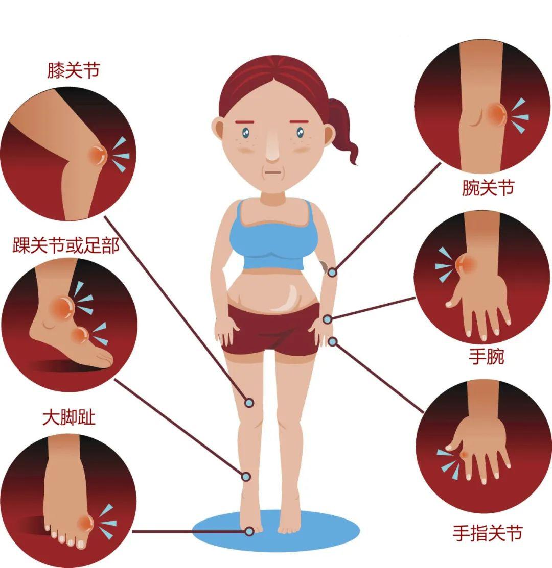 痛风好发作的部位在哪,痛风高发的人群有哪些