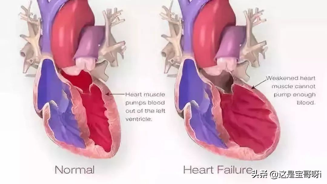 肌钙蛋白高了是心梗吗,肌钙蛋白高说明心梗严重吗