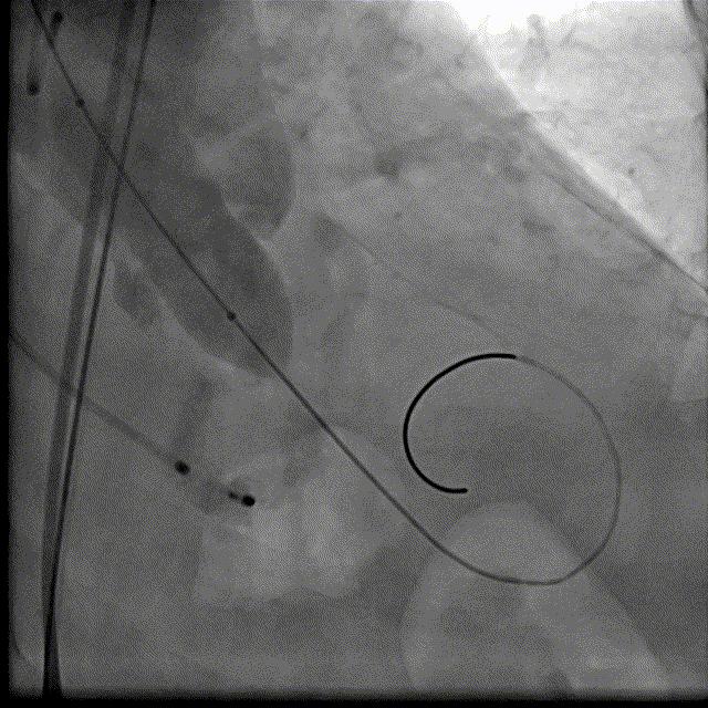 主动脉瓣狭窄病例讨论,25岁主动脉瓣狭窄用什么治疗方案