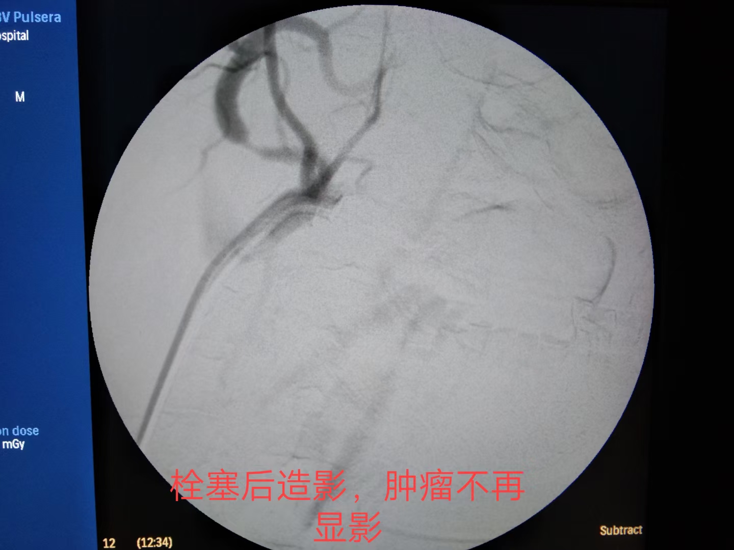 舌癌病例分享,舌癌吐血