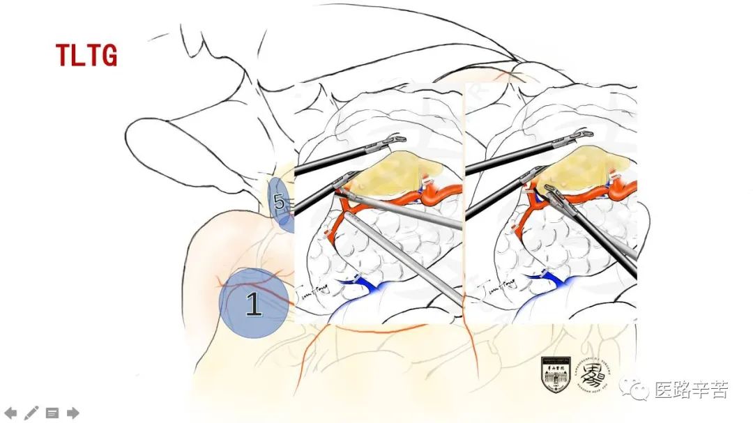 全腹腔镜胃癌根治术，学习大咖怎么清扫淋巴结
