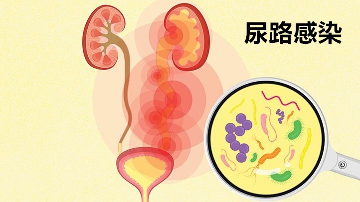 到了更年期得尿路感染怎么办,夏季女性尿路感染的主要原因