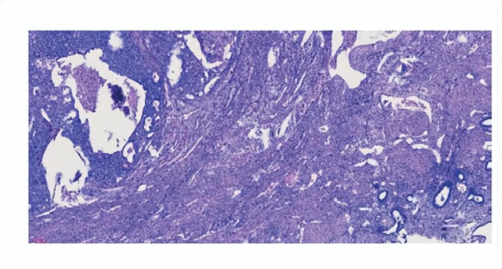 子宫腺肌症对女性的危害,为什么有子宫腺肌症的女性绝经晚