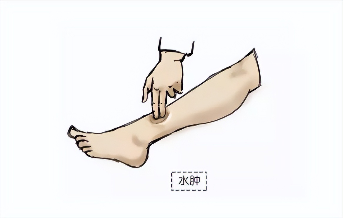 北京医院血管外科李鹏：下肢静脉曲张，不治疗的危害