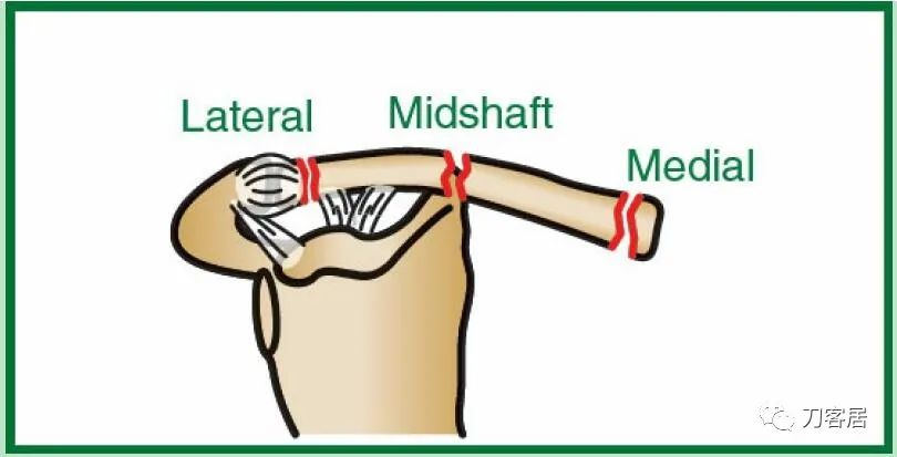 儿童锁骨骨折保守治疗的弊端,锁骨粉碎骨折错位不处理会愈合吗