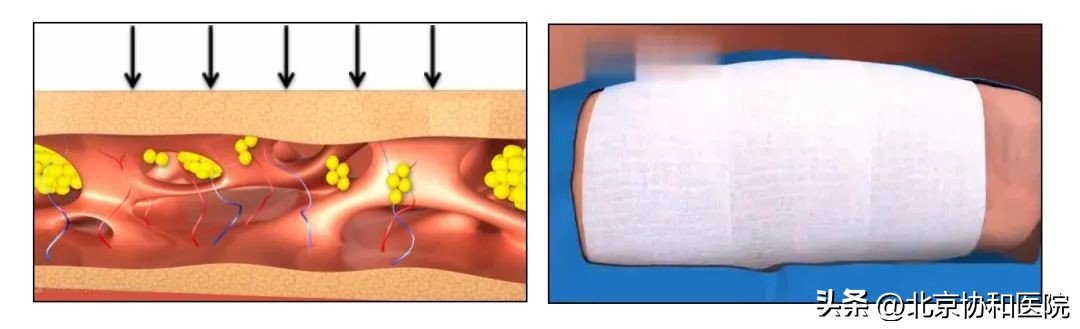 协和医院乳腺淋巴水肿,乳腺癌术后淋巴水肿专家共识