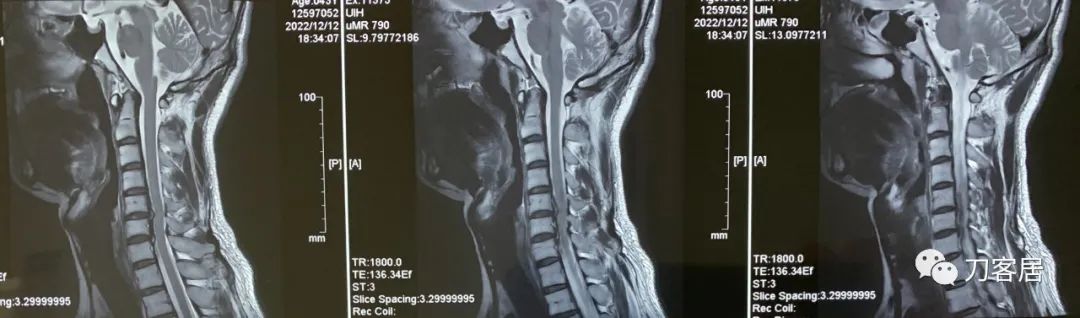 颈椎病七八年了到底要不要动手术,颈椎病不手术保守治疗可以吗