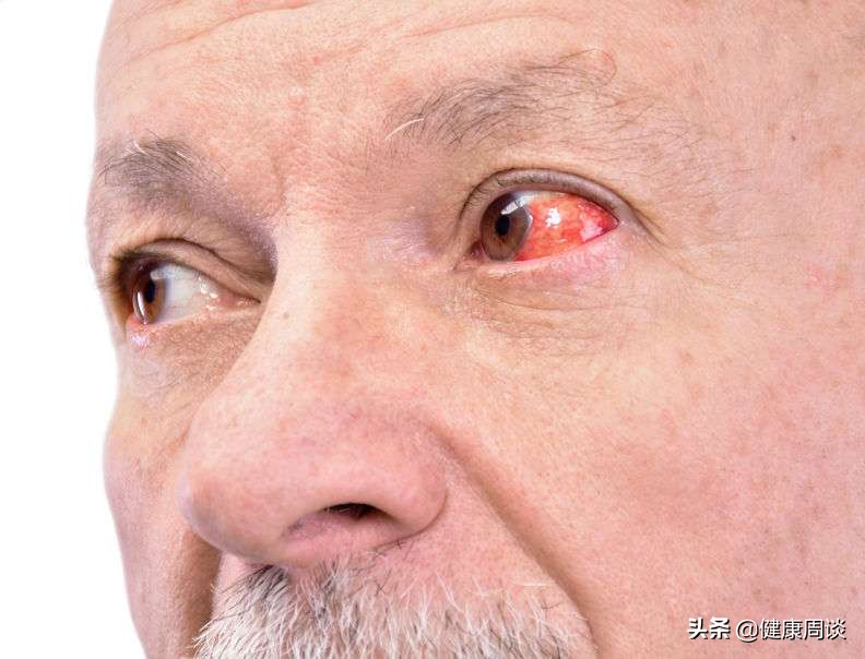 结膜炎和红眼病的症状有什么不同,结膜炎红眼病的6大表现症状