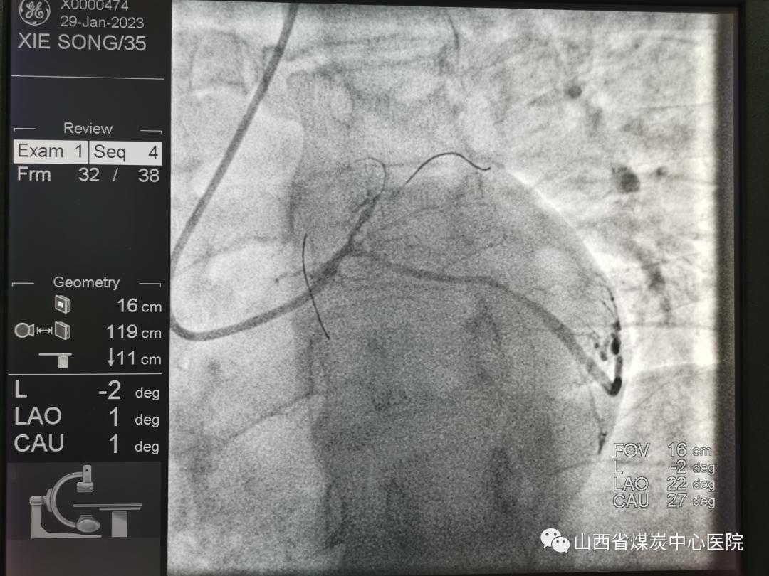 OCT辅助介入诊疗无植入！山西省煤炭中心医院成功抢救一名35岁急性心肌梗死患者