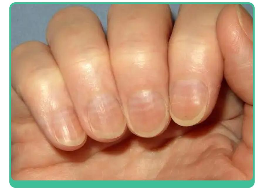 小孩指甲凹陷变黑有坑是什么原因,小孩指甲有白点和细纹是怎么回事