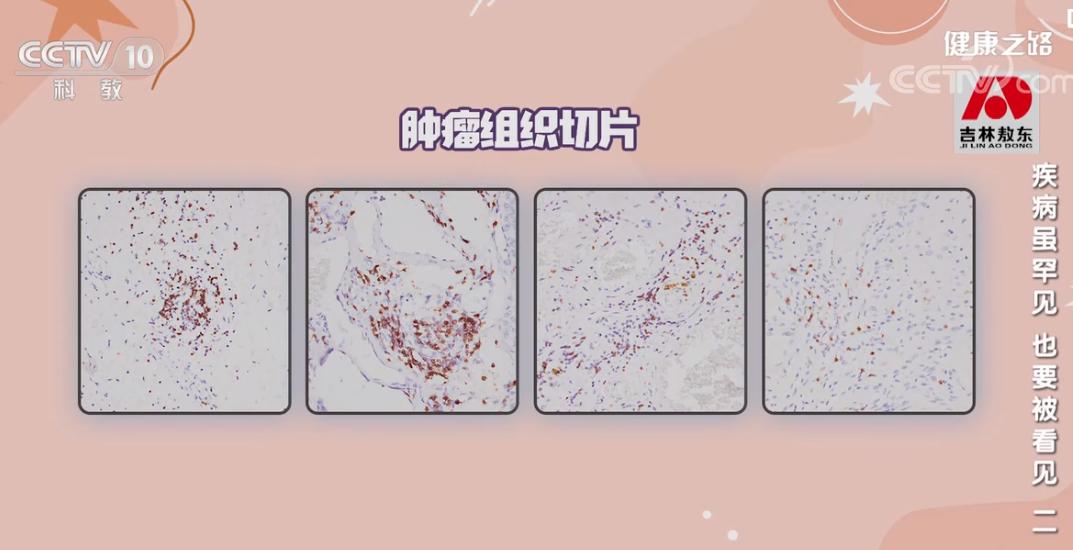 免疫疗法抗肿瘤效果图,央视新闻报道免疫细胞治疗癌症