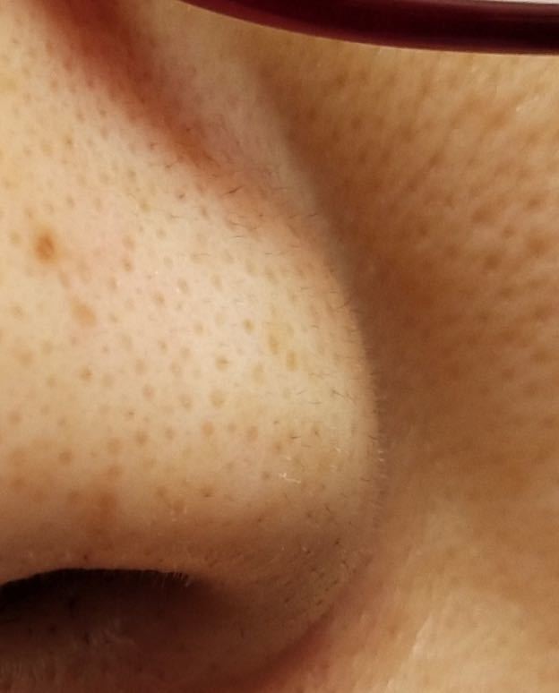 真黑头怎么去,黑头用黑头膏为什么去不掉黑头