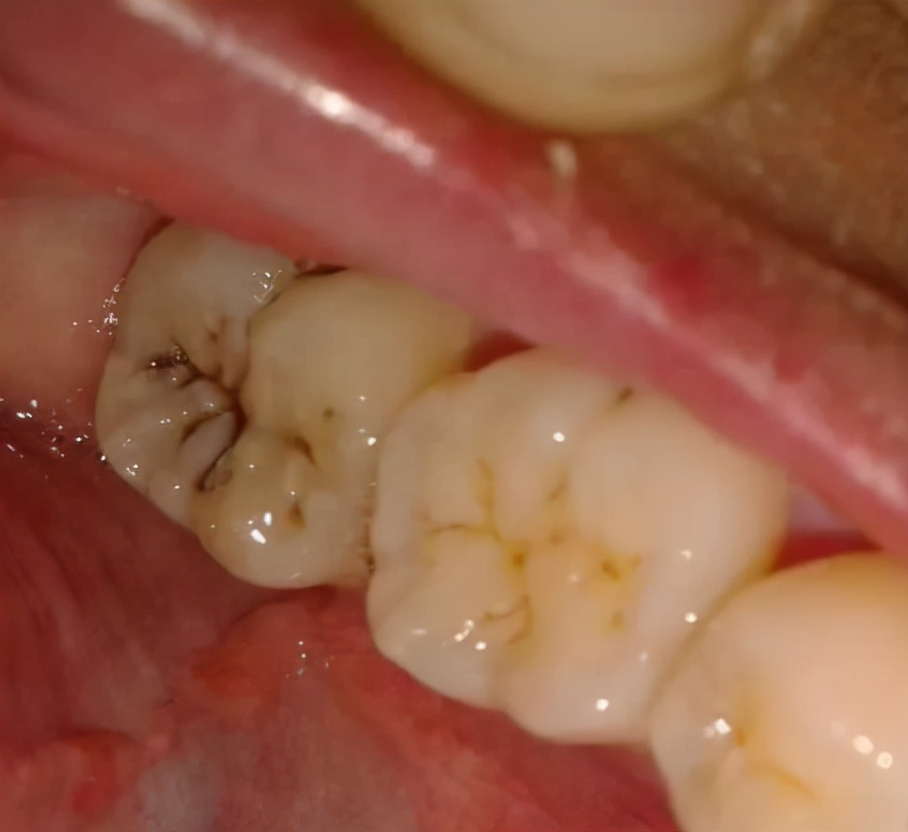 牙龈肿痛多久都不好什么原因,牙龈肿痛可能是哪种疾病的前兆