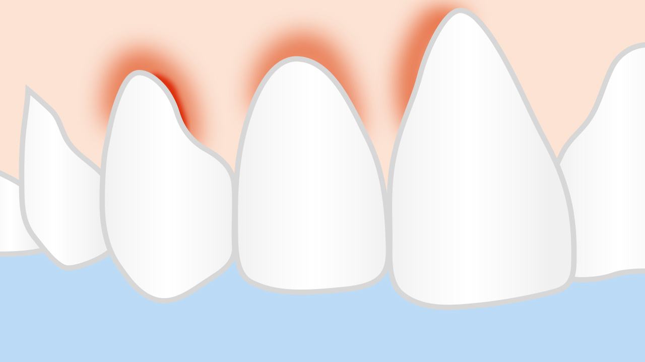 牙缝有牙结石怎么去除,牙缝间的牙结石怎么清除