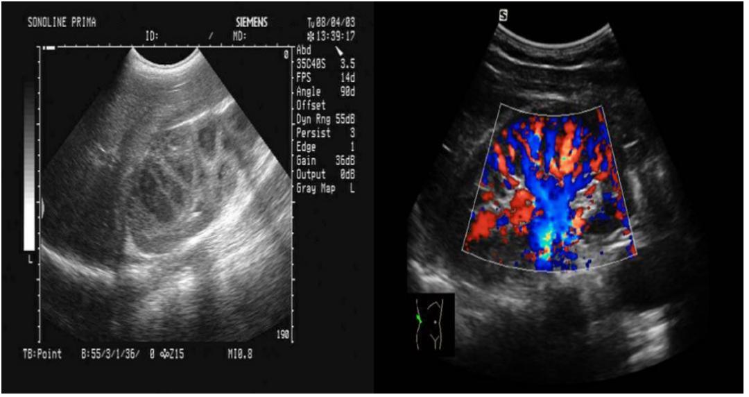 相对于黑白超声，彩超能检查出什么疾病？