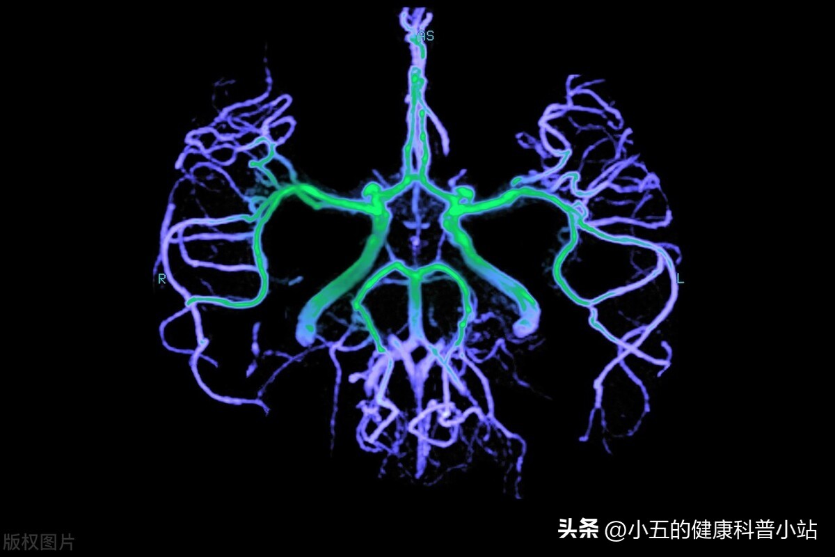 头晕脑供血不足怎么办快速缓解,经常头晕脑缺血吃什么药好
