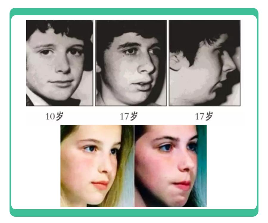 口呼吸矫正最佳方法不用呼吸贴,口呼吸贴嘴