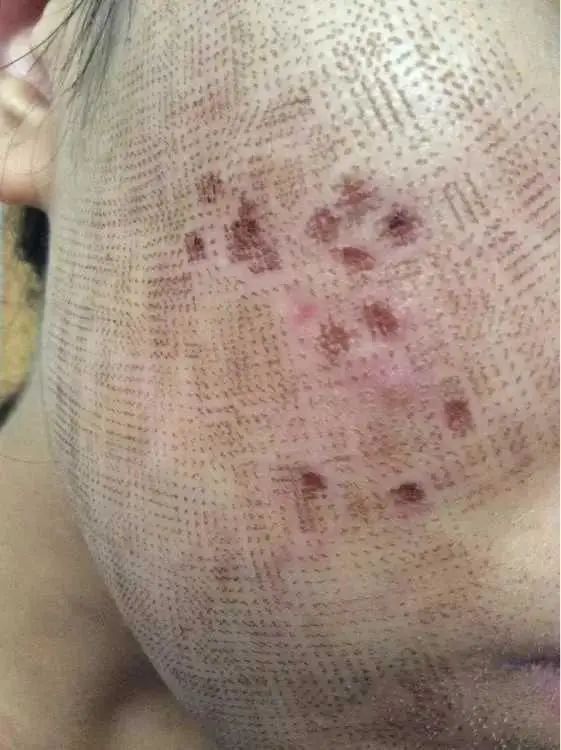 医学那么发达为什么治不了痘坑,想治痘坑但没钱怎么办