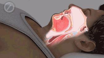 打呼不是病打起来要人命,打呼是一种病吗怎么治