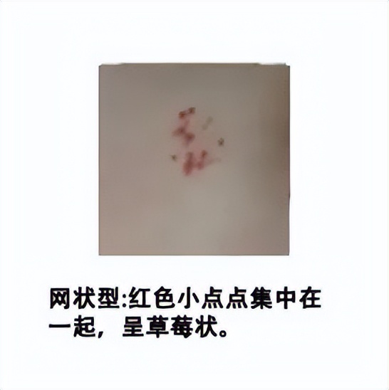 小孩胎记长肉瘤,小孩身上一块黑色胎记越长越大