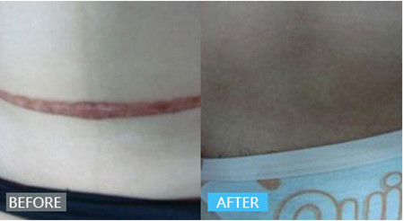 3个月的疤痕增生还能消除吗,莫名其妙长了个增生疤痕