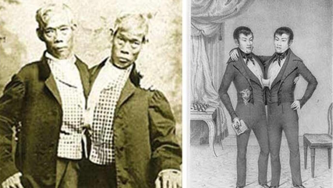 连体人该怎么结婚生子,邦克兄弟连体人