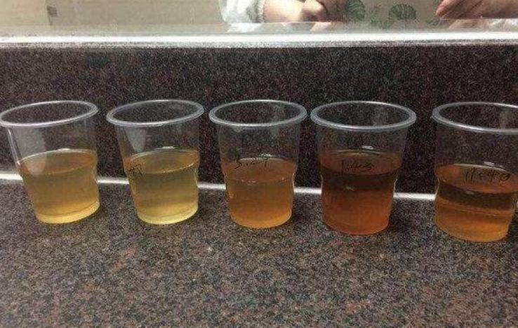 男人尿多警惕尿毒症,男人得了尿毒症会有什么表现